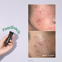 Load image into Gallery viewer, Zarzou - Acne Control Gel (ACG)
