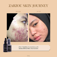 Load image into Gallery viewer, Zarzou - Basic Acne Care
